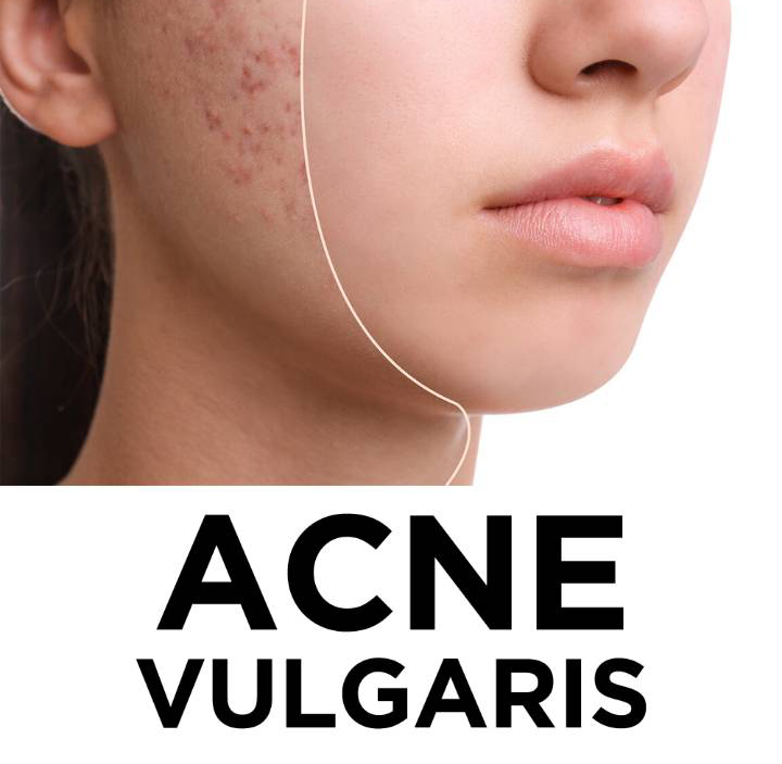 ACNE VULGARIS